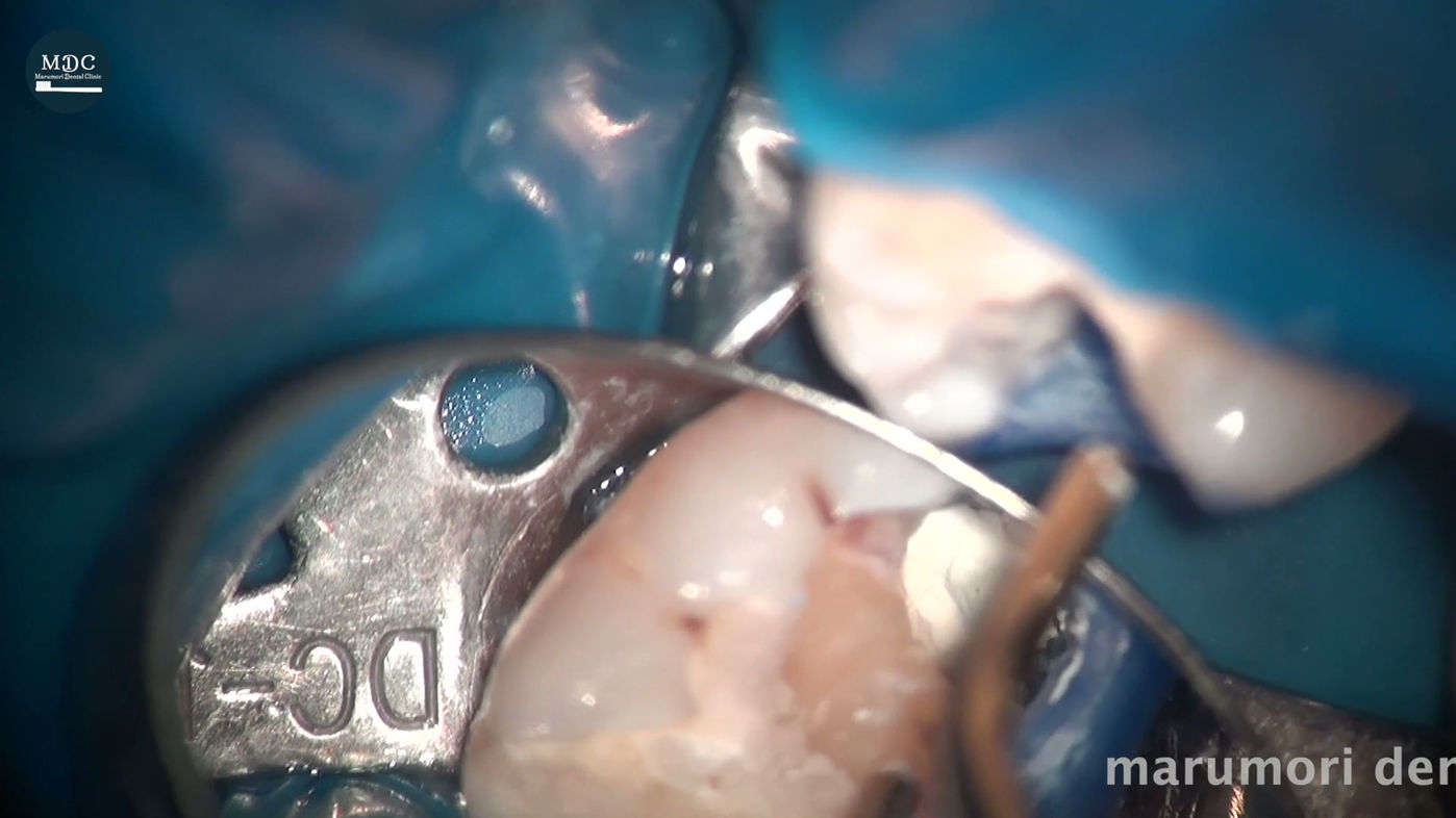 Cvek (Partial) Pulpotomy
